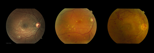 retina-medica-retinopatia-diabetica